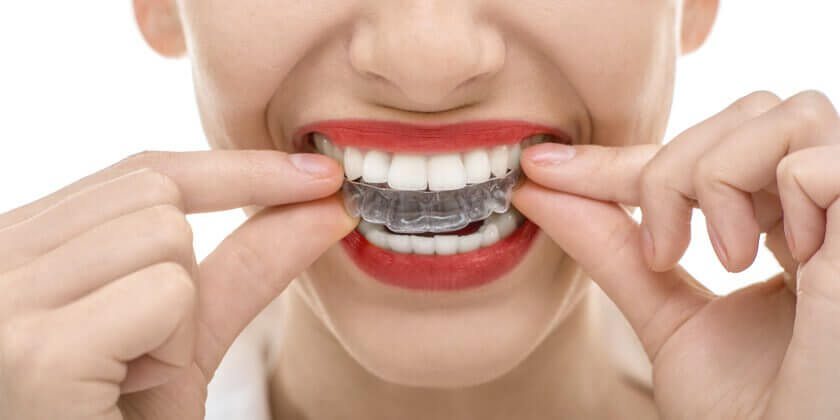 Kvinna med tandskydd