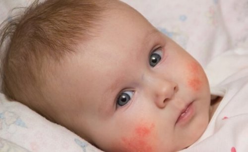 Bebis med dermatit