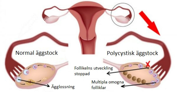 Polycystiskt ovarialsyndrom