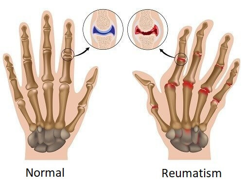 Hand med reumatism