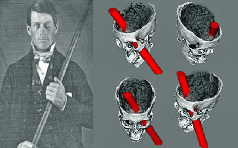 Phineas Gage med sitt spett