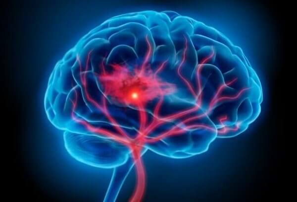 Neuroinflammation som orsak till depression enligt inflammationsteorin