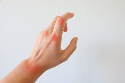 Hand med reumatism