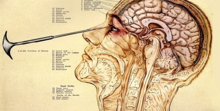 Illustration av lobotomi.