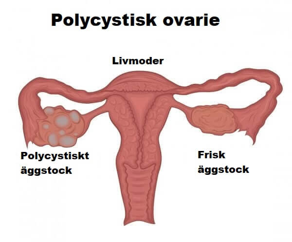 Lär dig allt om polycystiskt ovariesyndrom