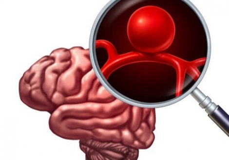 aneurysm i hjärnans blodkärl