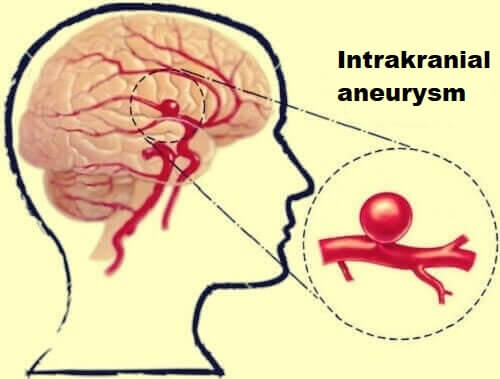 Vad är intrakranial aneurysm i hjärnan?