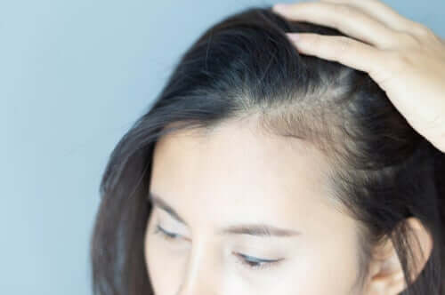 androgen alopeci kvinnor