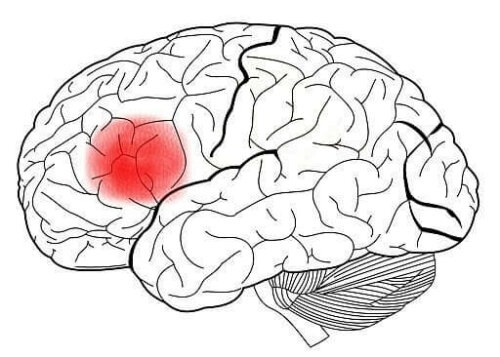 Hjärnan med Brocas område markerat med rött