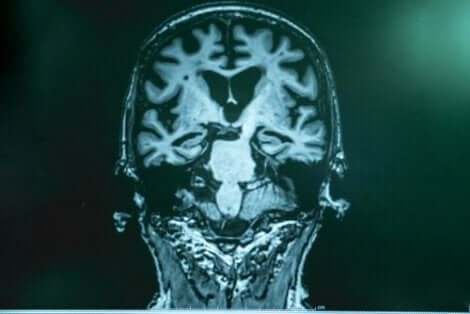 Vid Alzheimers anhopas amyloid i hjärnan