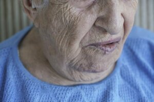 Ansiktsförlamning och känslomässig anknytning