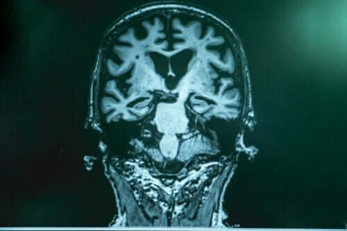 En röntgenbild av en hjärna