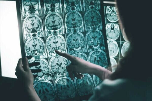 Hjärnstimulering för personer med Alzheimers sjukdom