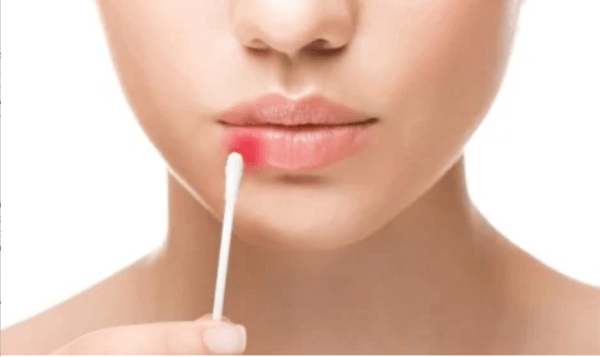 Sambandet mellan stress och munsår gör att vi måste komma åt underliggande emotionella problem