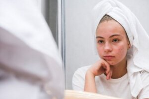 Den psykologiska effekten av akne i tonåren